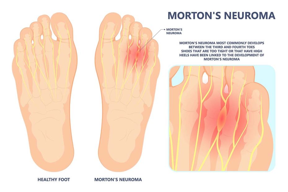 Morton Neurom | Behandlung beim Orthopäden aus 1190 Wien