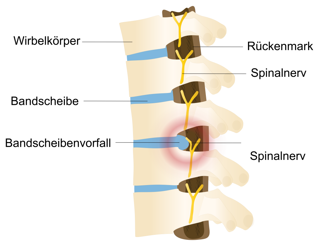 Bandscheibenvorfall - Bandscheibenoperation nötig?
