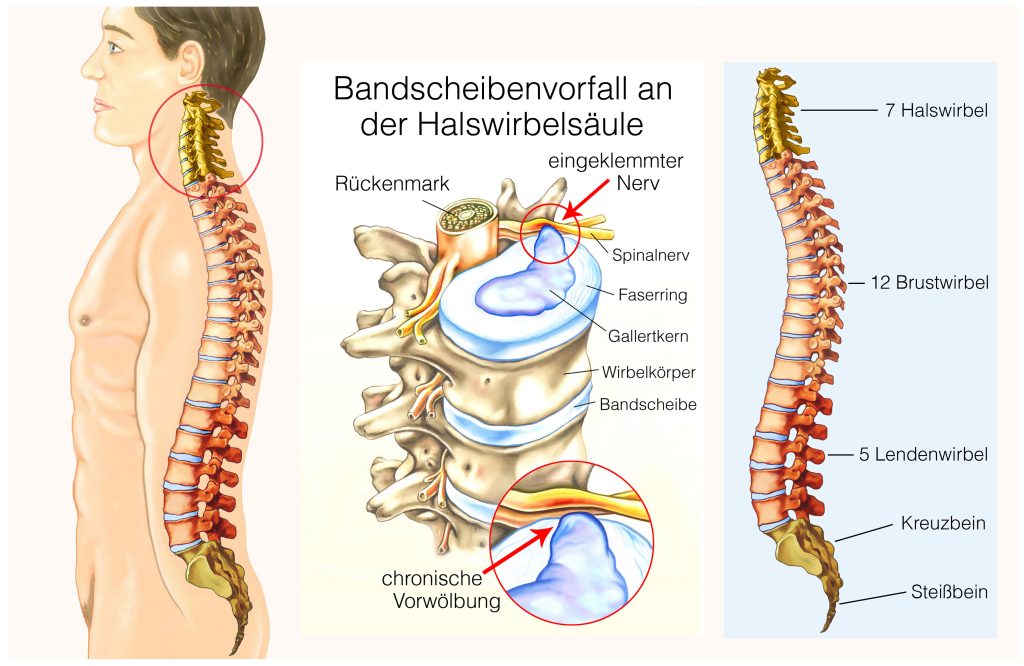 Bandscheibenvorfall behandeln Wien