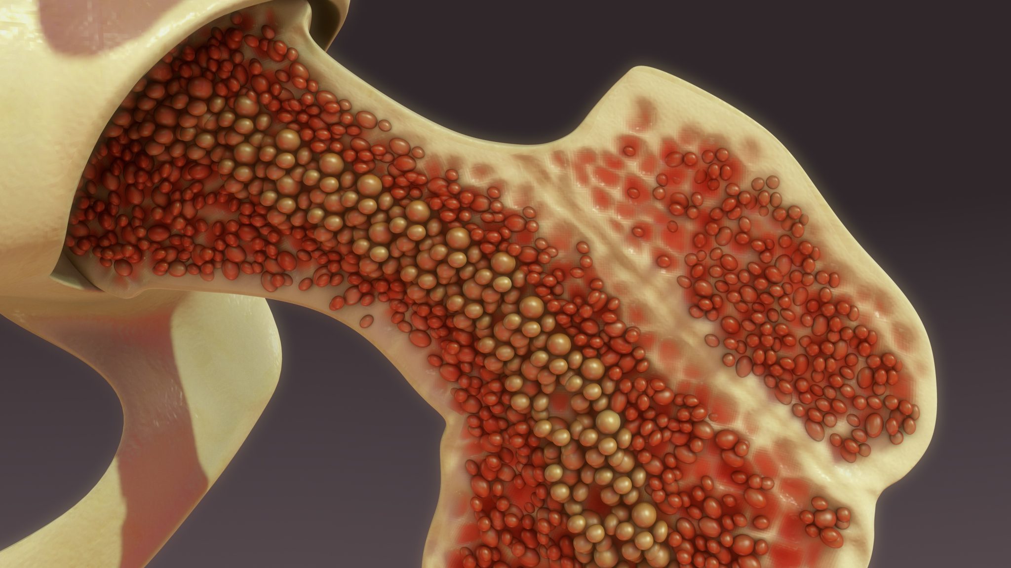 Wie Gefährlich Ist Ein Knochenmarködem www.orthopaedie-nepp.at