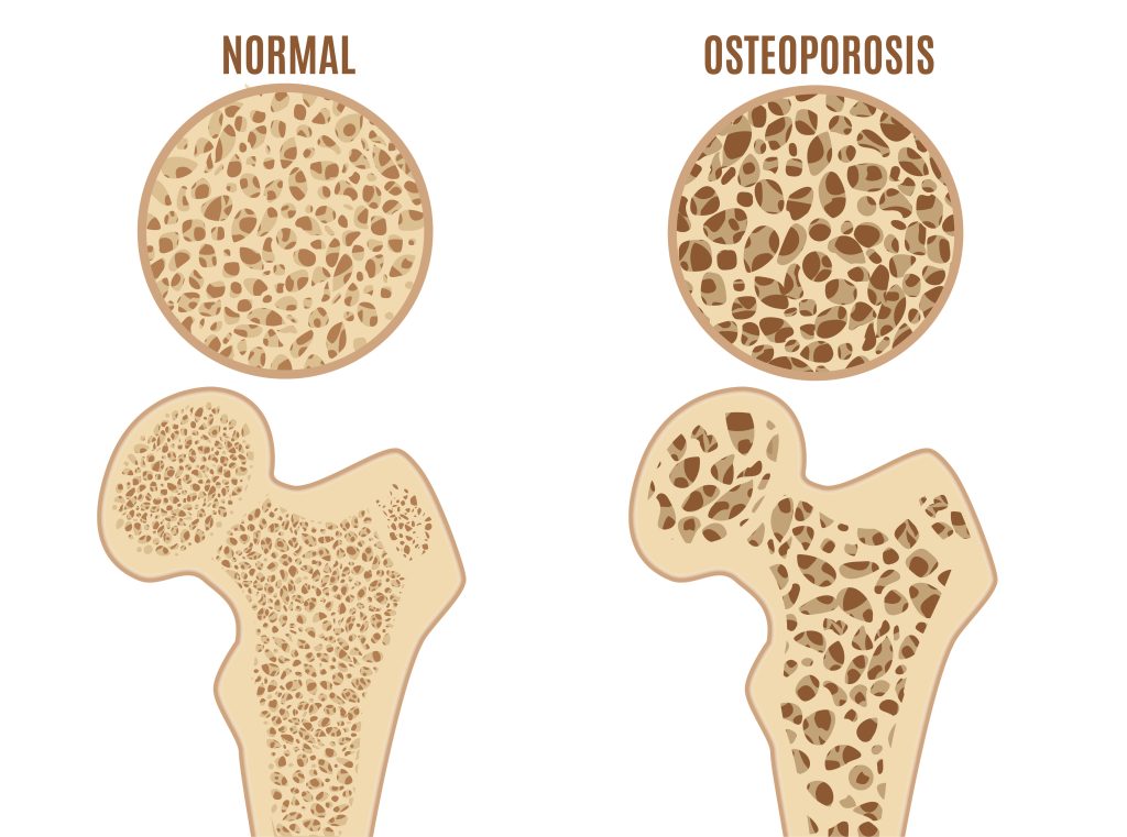 vergleich osteoporose keine osteoporose